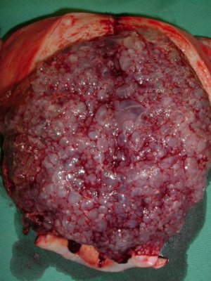 MOLAR PREGNANCY
