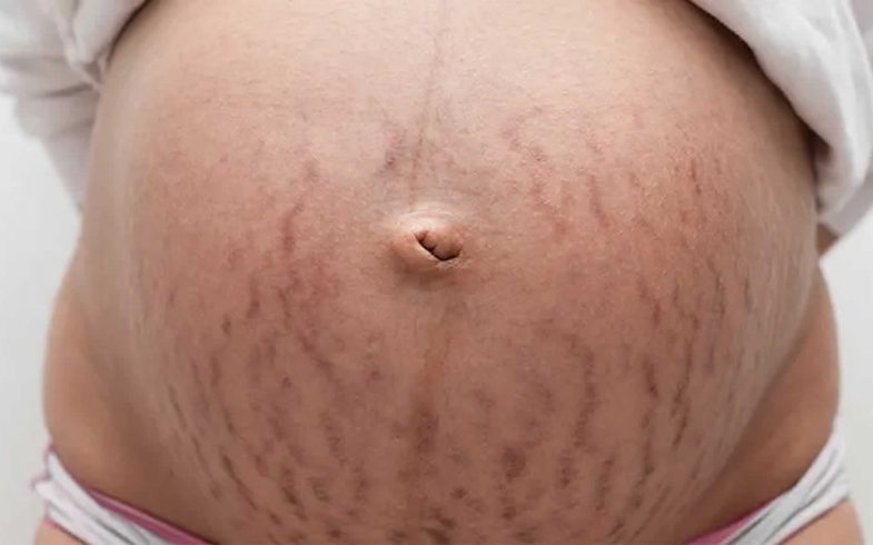 STRETCH MARKS DURING PREGNANCY (STRIAE GRAVIDARUM)